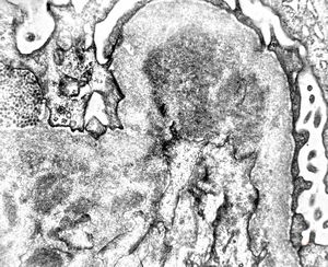 F,28y. | type III membranoproliferative glomerulonephritis F,28y. | type III membranoproliferative glomerulonephritis
